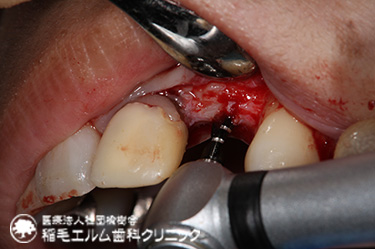 前歯インプラント治療
