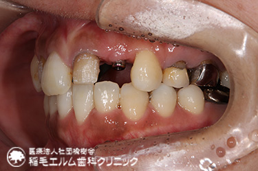 前歯インプラント治療